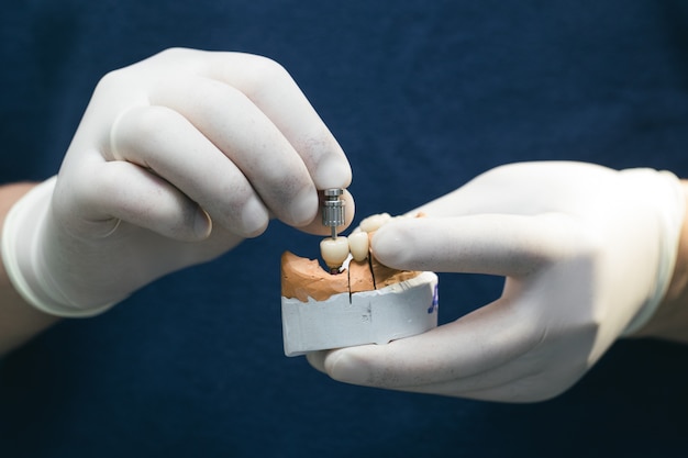 Premium Photo | Ceramic teeth with the implant on a plaster model ...