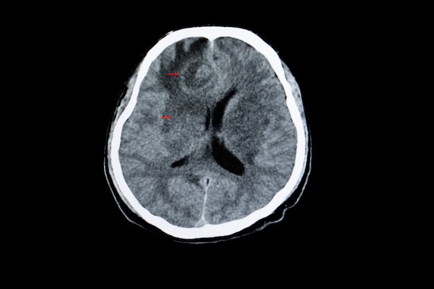 Premium Photo | Cerebral toxoplasmosis infection