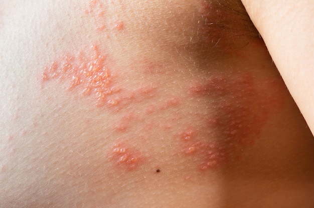 Premium Photo Chickenpox Rash Shingles Varicella Zoster Virus Skin Rash And Blisters On Body Skin Infected Herpes Zoster Virus Herpes Virus On Body Urticaria Rash Atopic Dermatitis