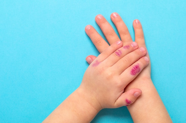 皮膚炎で子供たちの手 手に湿疹 青色の背景に分離 プレミアム写真