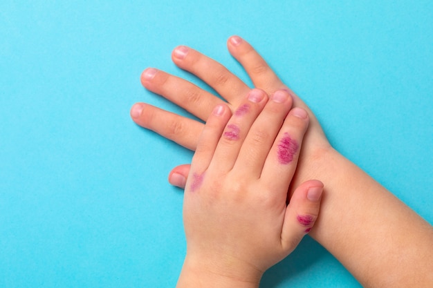 皮膚炎で子供たちの手 手に湿疹 青色の背景に分離 プレミアム写真