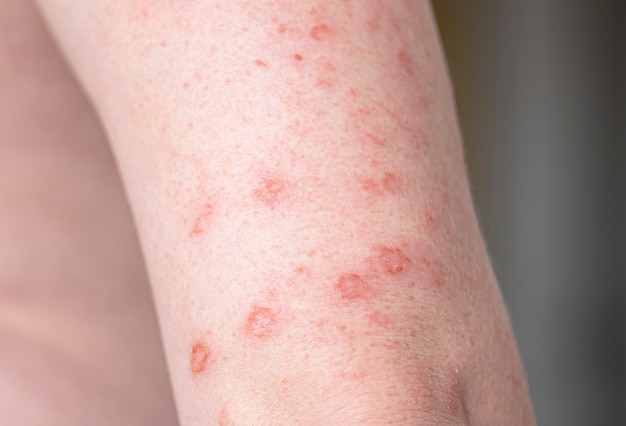 Close-up body with allergic rash, eczema on hands, skin with red bumps and blisters Premium Photo