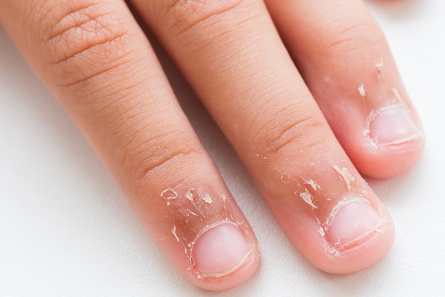 Premium Photo | Close up child's fingers with dry skin, eczema dermatitis