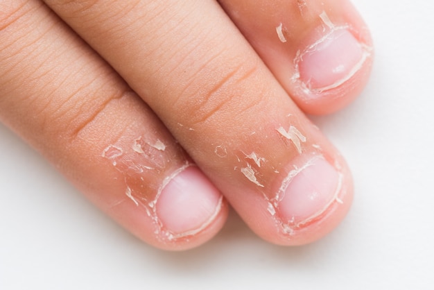 a-tender-rash-on-the-hand-dermatology-jama-the-jama-network