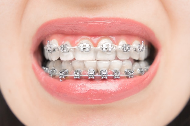 braces brackets without rubber bands