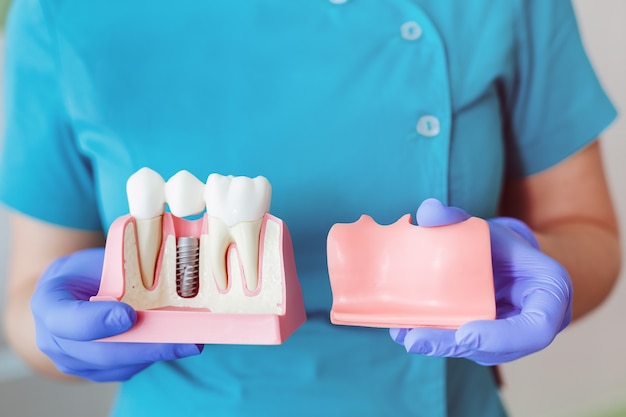 Premium Photo | Close up of a dental implant model. hands of the ...