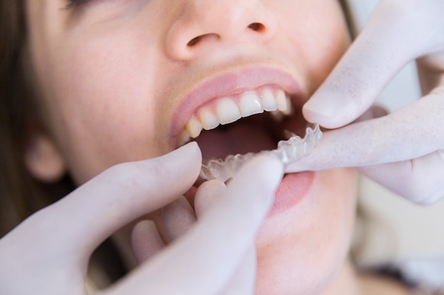 Close-up of a dentist's hand fixing transparent aligner to female patient's teeth Free Photo