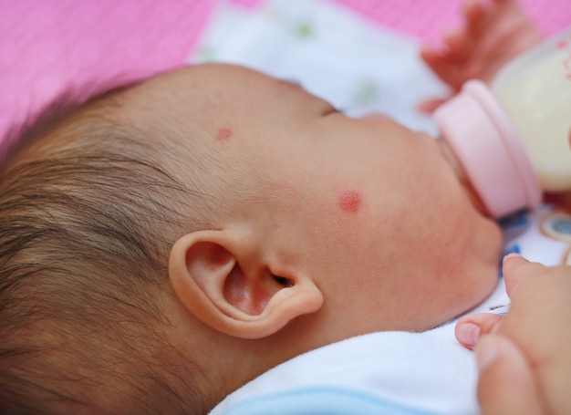Premium Photo Close Up Face Of Infant Have A Mosquito Bites