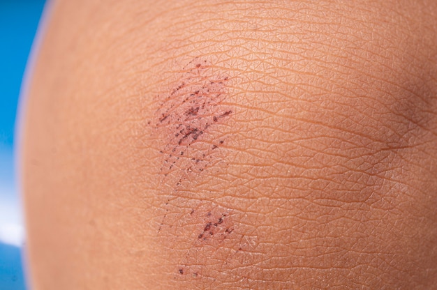 Premium Photo | Close up of little scab wound on kid's knee