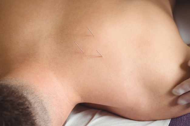 Intramuscular Stimulation/Dry Needling - PhysioPlusPhysioplus Whitehorse