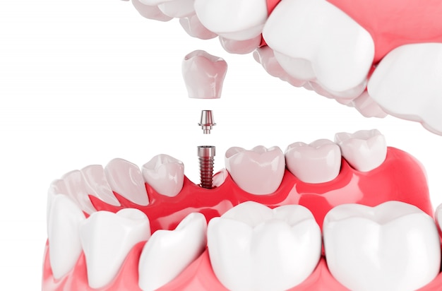 Close up process implants teeth health care. selective focus. 3d render. Premium Photo