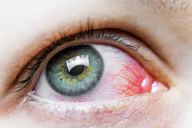 premium-photo-close-up-of-a-severe-bloodshot-red-eye-viral