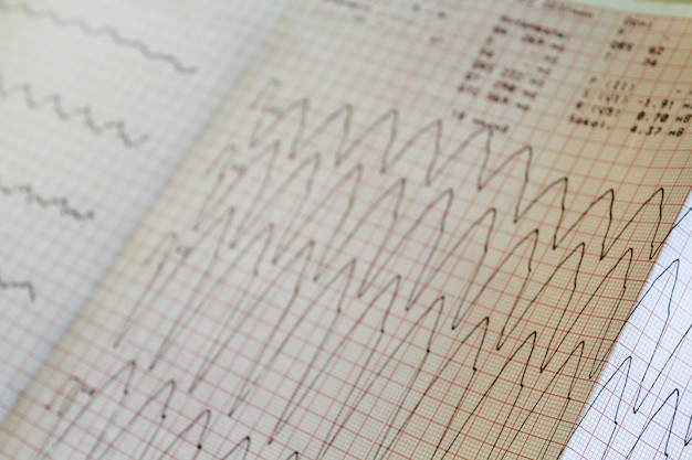 Premium Photo | Close up view of an electrocardiogram paper.