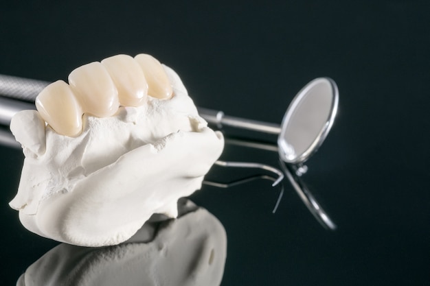 Premium Photo Closeup Prosthodontics Or Prosthetic Tooth Crown And Bridge Implant