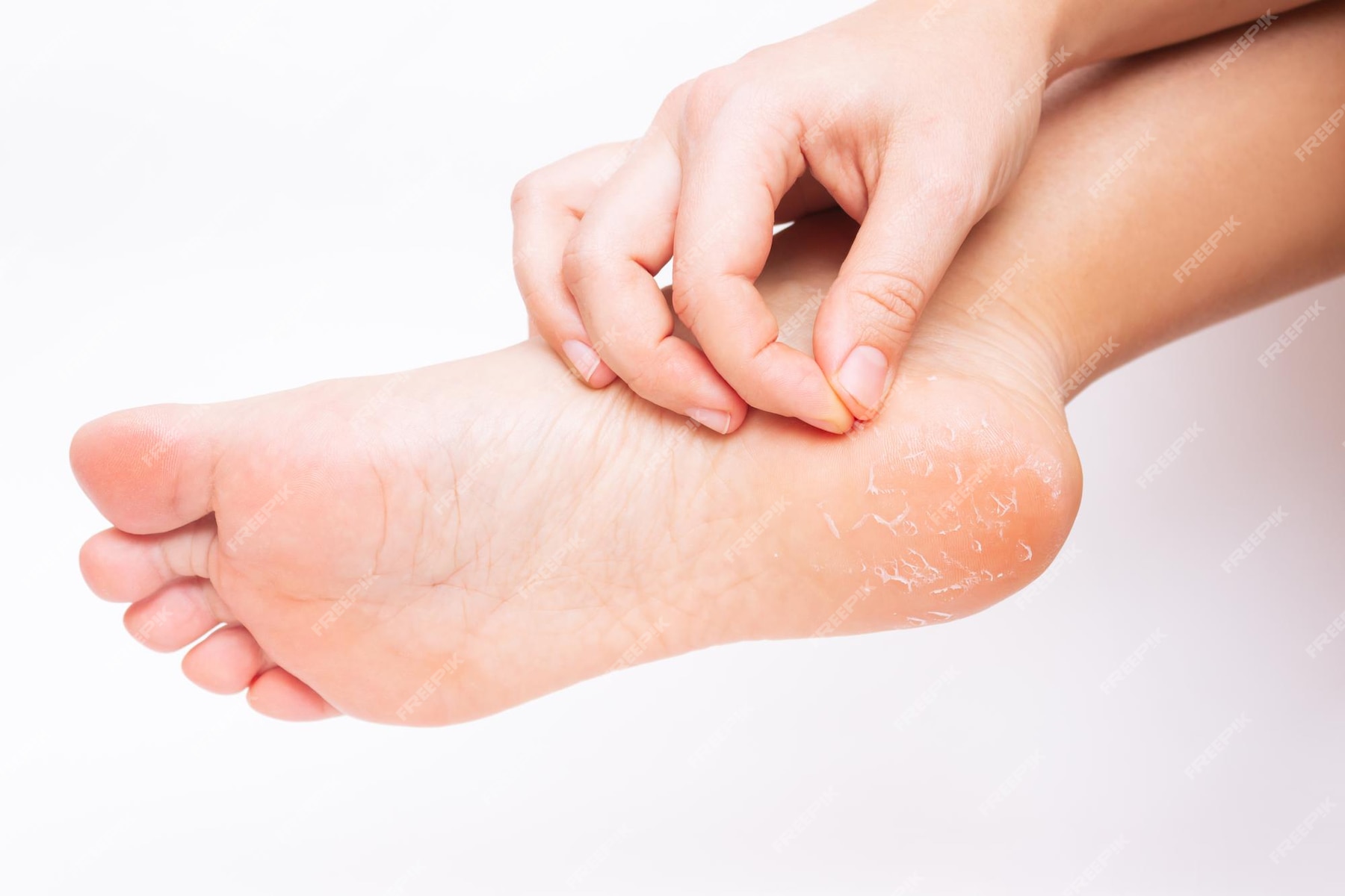 Premium Photo Closeup Of A Womans Foot With Peeling Skin On The Heel