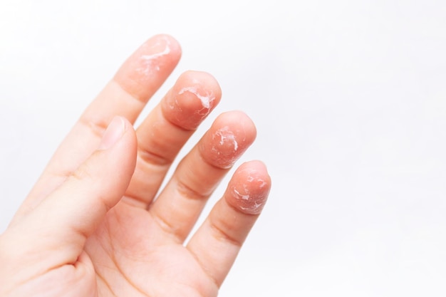 premium-photo-closeup-of-womans-hand-with-peeling-skin-on-fingers