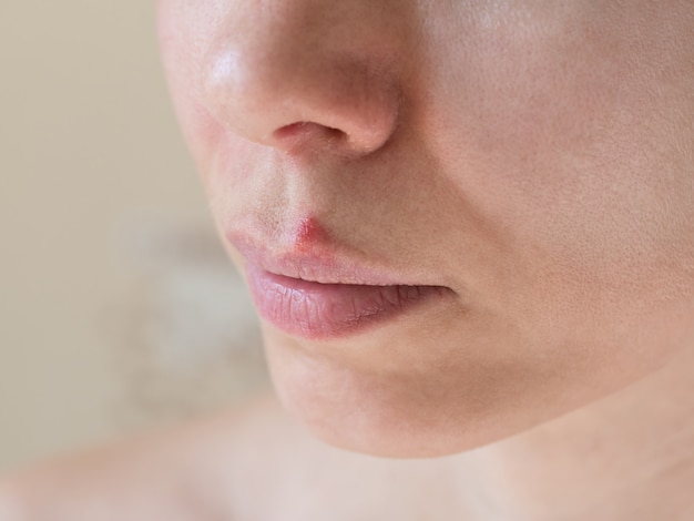 Premium Photo | Cold sores. close-up of the female face, selective focus.