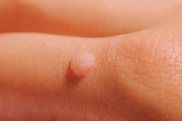 Wart on foot spiritual meaning, Hpv vs herpes symptoms.