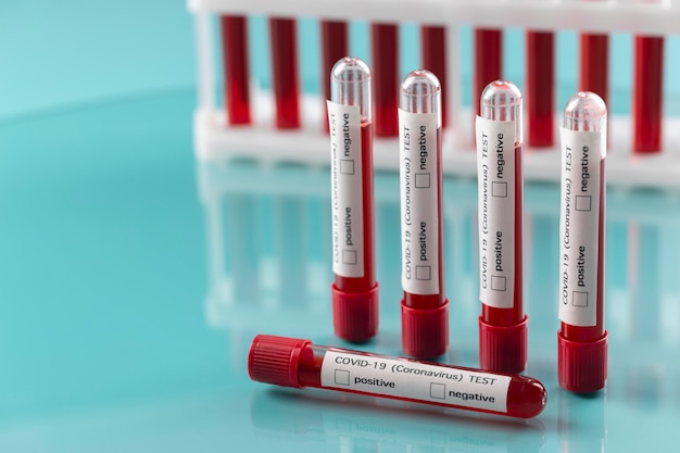 Free Photo | Coronavirus blood samples arrangement in lab