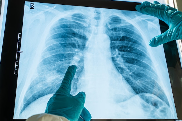 コロナウイルス肺炎の概念。人間の胸部肺のレントゲン写真x線フィルム 
