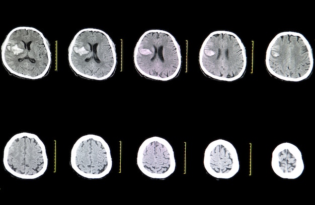 Premium Photo | Ct brain scan of a stroke patient