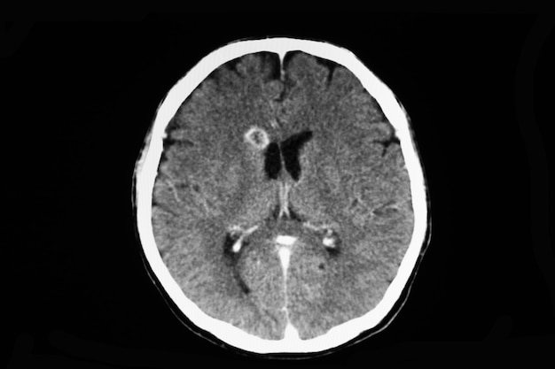 Premium Photo | Ct scan of a patient with brain abscess