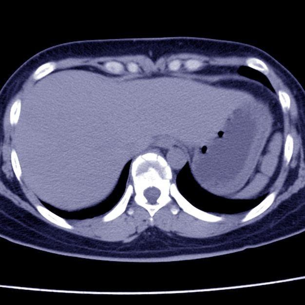 Ct scan of thoracolumbar spine mild compression fracture of t9 and t10 ...