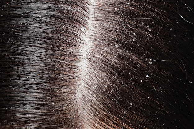 Premium Photo | Dandruff on woman's dark hair