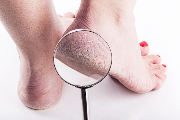 Dehydrated skin on the heels of female feet Premium Photo