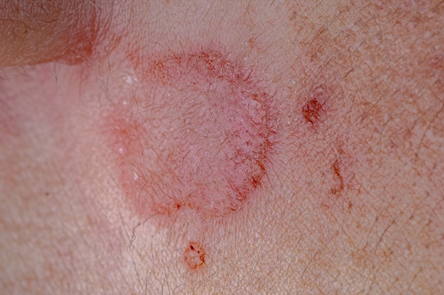 Premium Photo | Dermatitis skin damage caused by beetle of the ...