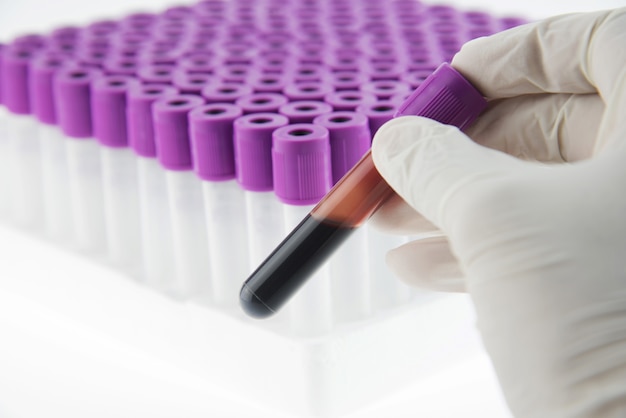 Premium Photo Edta Blood Tube For Cbc Test In Laboratory