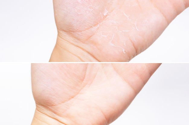 Premium Photo A Female Hand Before And After Treatment Of Peeling Skin On The Palm Isolated On 8754