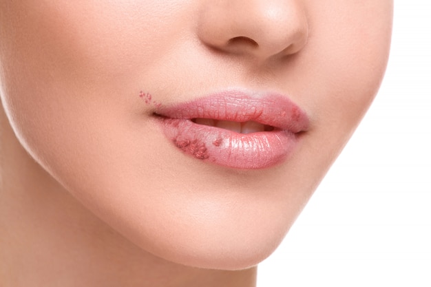 ヘルペスウイルスに感染した女性の唇 プレミアム写真