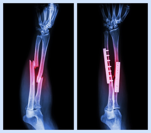 Arm Bone Fractures