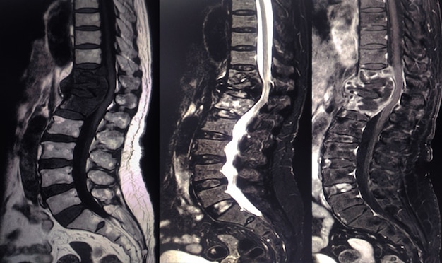 Premium Photo | Fracture of t12 with bone destruction of t11 and l1.