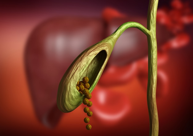 Gallbladder cutting showing gallstones obstructing bile duct on organic background. 3d rendering Premium Photo