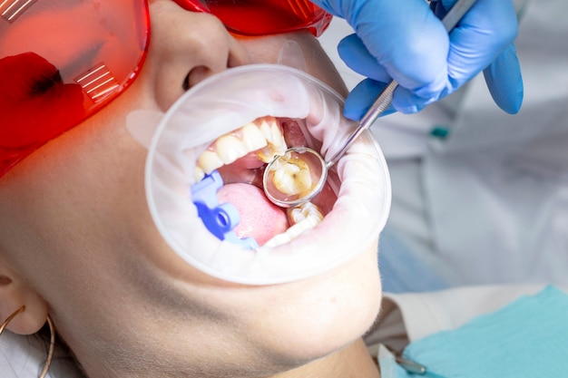 歯科医のレセプションの女の子 う蝕歯の治療 あなたの歯の上に虫歯 歯科医は治療 鏡 ホウ素機械に特別な医療器具を使用します プレミアム写真