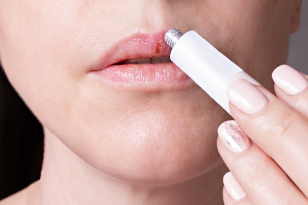 若い女性の唇にヘルペス 唇唇ヘルペス軟膏を滑らかにする女性 プレミアム写真