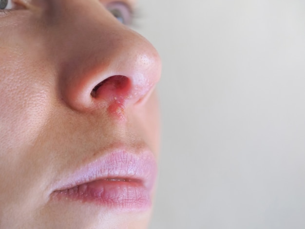 鼻 ヘルペス に なる 原因