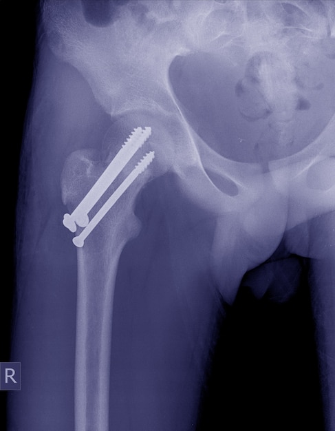 Premium Photo Hip Fractures With Post Operation Internal Fixation Device