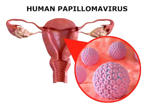 human papillomavirus infection not sexually transmitted)
