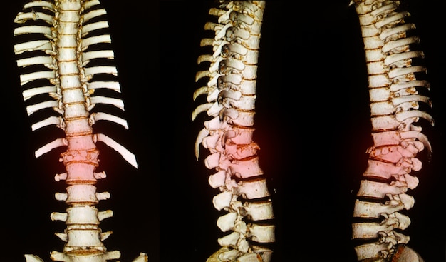 vertebral column discs