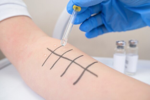 Premium Photo | Immunologist doing skin prick allergy test. redness and ...