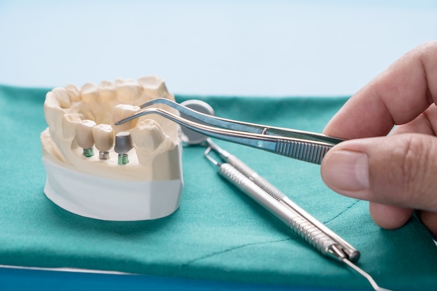 Premium Photo | Implan model tooth support fix bridge implan and crown.