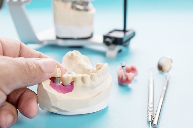 Premium Photo | Implant prosthodontics or prosthetic