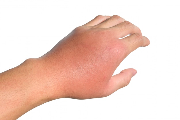 inflammation-swelling-redness-of-the-hand-shows-infection-insect