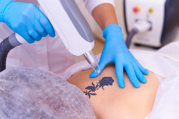 Premium Photo | Laser tattoo removal in a cosmetology clinic.
