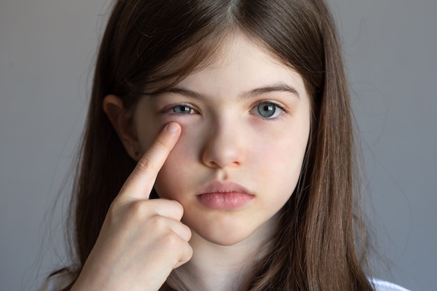 Premium Photo Little Girl Has An Eye Pain Eye Injury Conjunctivitis Allergies A Child Has Swollen Eyes