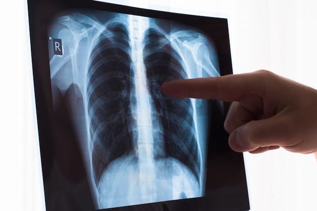 Lung radiography concept. radiology doctor examining at chest x ray film of patient lung cancer or pneumonia. Premium Photo