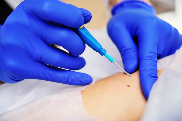 Medical surgical treatment removal of a mole on the hand of a young woman patient Premium Photo